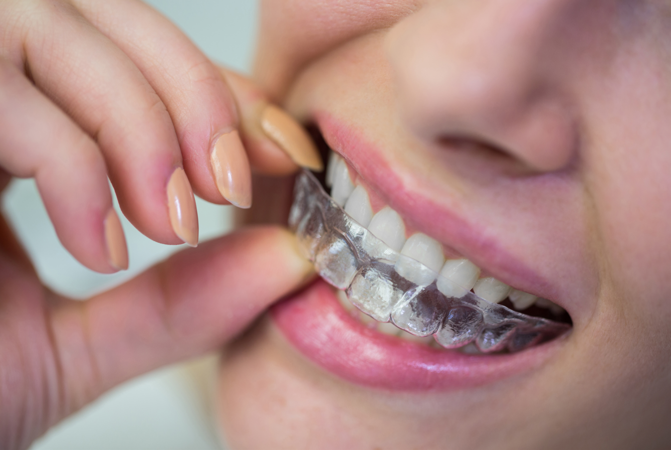 Patient with clear aligner
