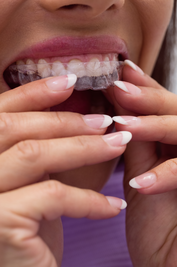 Patient with clear aligner